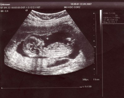 Ultrazvuk plodu ve 12. týdnu
