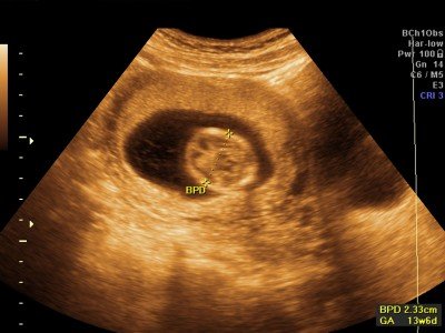 Ultrazvukové měření hlavičky plodu (BPD)