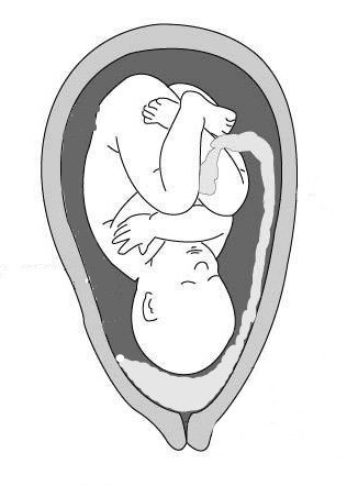 Vcestné lůžko (placenta previa)